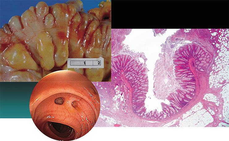 Сигмовидная кишка (отдел толстого кишечника) с множественными выпячиваниями (дивертикулами) размером до 1 см и более. Воспаление дивертикула (дивертикулит) может приводить к развитию флегмоны и перфорации стенки кишечника, перитониту и абсцессу. Масштаб в см. Public Domain. Этот образец ткани (справа) взят у больного дивертикулитом, который проявился острым гнойным воспалением, распространившимся на подлежащую жировую ткань. © CC BY-SA4.0/ CoRus13. Слева внизу – эндоскопическое изображение толстой кишки с дивертикулезом. У большинства (80 %) таких больных симптомы отсутствуют или проявляются в периодических запорах. © CC BY-SA 2.0/ MAC 06