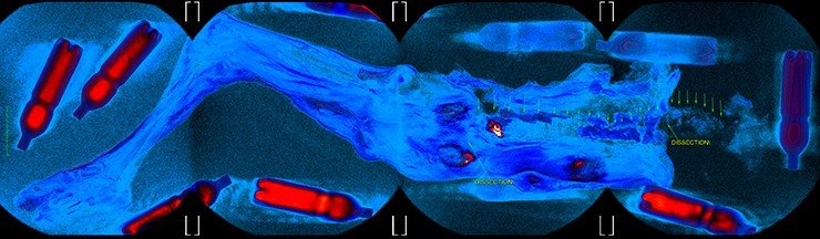 General view of the 3D conversion of MRIs. Pseudocolor mapping identifies locations with maximum liquid content. Imaging was performed in a 4-stations mode – you can see the zones of virtual "crosslinking" tomograms (each field of view is 48 cm)