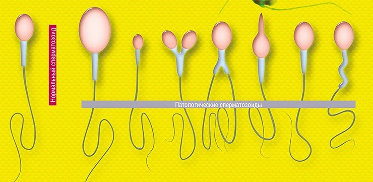 Дополнительное исследование спермы – определение морфологии сперматозоидов по Крюгеру – позволяет максимально точно выявить патологии в строении сперматозоидов