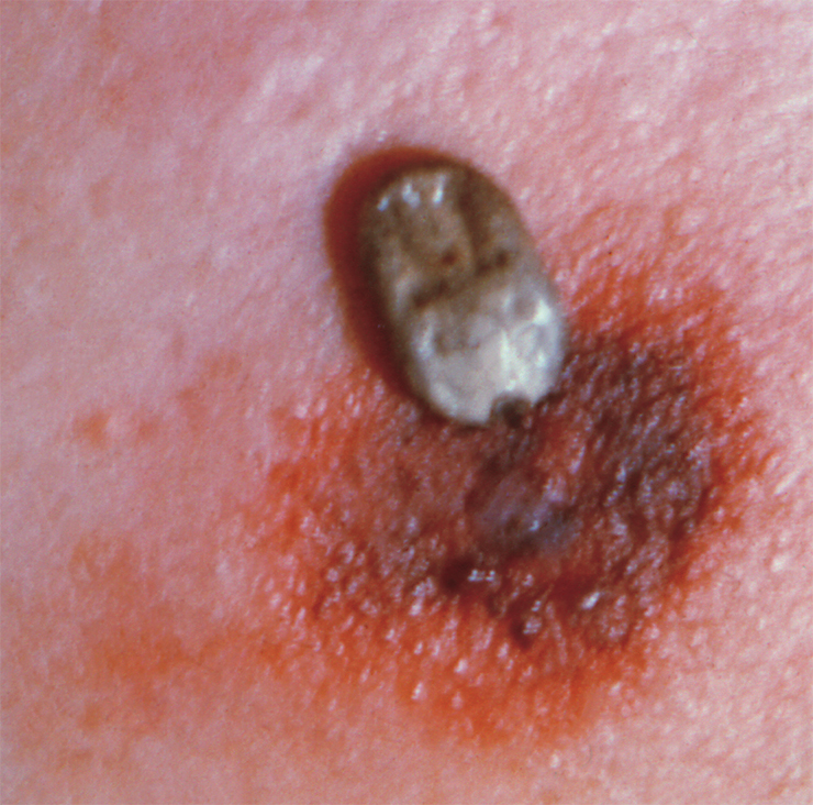 A wood tick (Dermacentor andersoni), full of blood, on the back of a man. Noteworthy is the unusually strong local reaction in the form of reddening and inflammation at the bite site. © CDC/NIAID