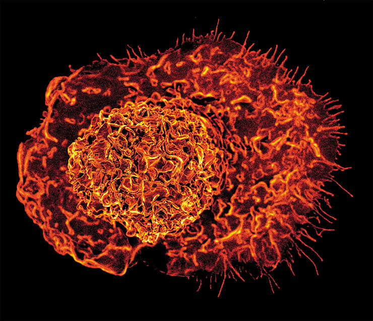 «Пожиратель»-макрофаг человека, раскрашенный в цвета Хеллоуина. Сканирующая электронная микроскопия. © CC BY 2.0/NIAID