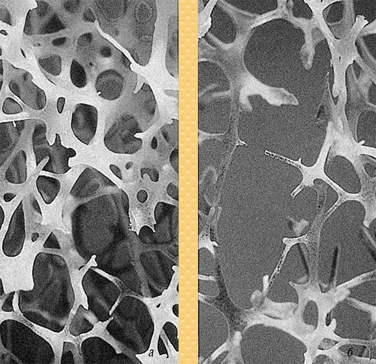 При остеопорозе меняется микроархитектура кости. По сравнению со здоровой костью (а), плотность минерального вещества снижается, а костные балки истончаются (б). © CC BY-SA 3.0. Some rights reserved by Gtirouflet