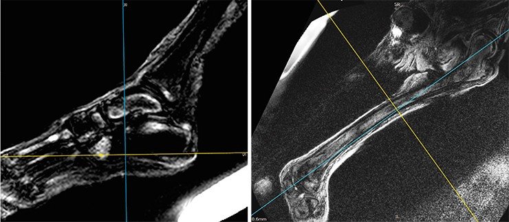 Томограммы костей и суставов левой нижней конечности – субхондральные диффузные отечно-эррозивные изменения суставного хряща головки бедренной кости.В дистальной части диафизарной полости левой бедренной кости (справа) – отечно-склеротические очаги; в патоморфологическом плане эти изменения более всего соответствуют остеосклеротическим последствиям остеомиелитического процесса в подостро-хронической фазе. Изменения левого коленного сустава укладывается в МР-картину дегенеративно-дистрофических изменений с низкоэнергетическими отеками по типу остеоартрита. В костях левой стопы (слева) – очаги с отечной периферией и с МР-плотными (темными) центральными зонами, интерпретированные нами ранее как проявления онкологического метастатического процесса (Letyagin et al., 2014) в сочетании с дегенеративно-дистрофическими изменениями по типу остеоартрита с низкоэнергетическими отеками
