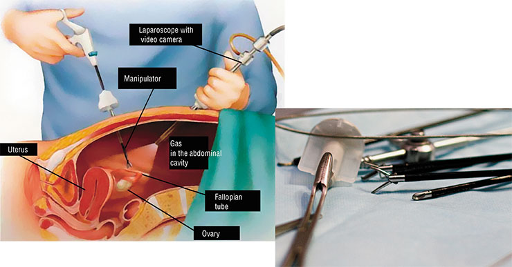 These unusual looking surgical tools are used for endoscopic surgery