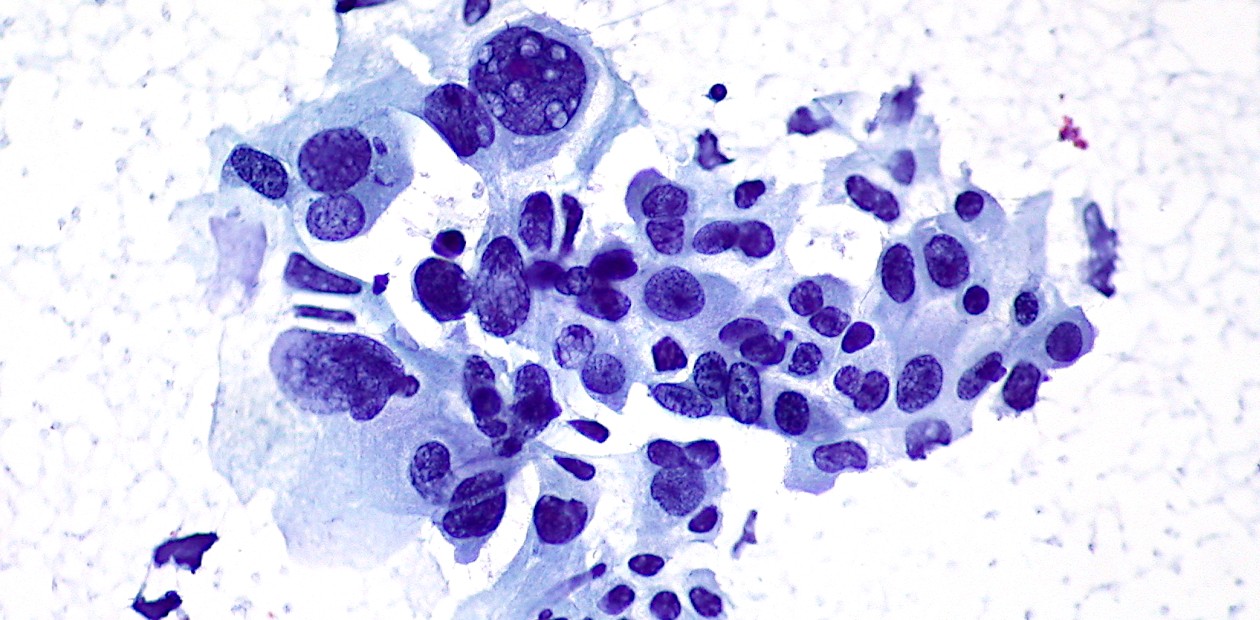 Старение и рак – нелинейная связь?