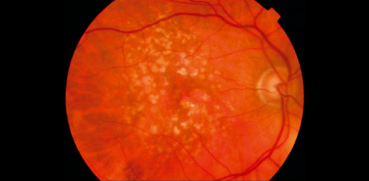 На пути к клеточной терапии возрастной дегенерации сетчатки глаза