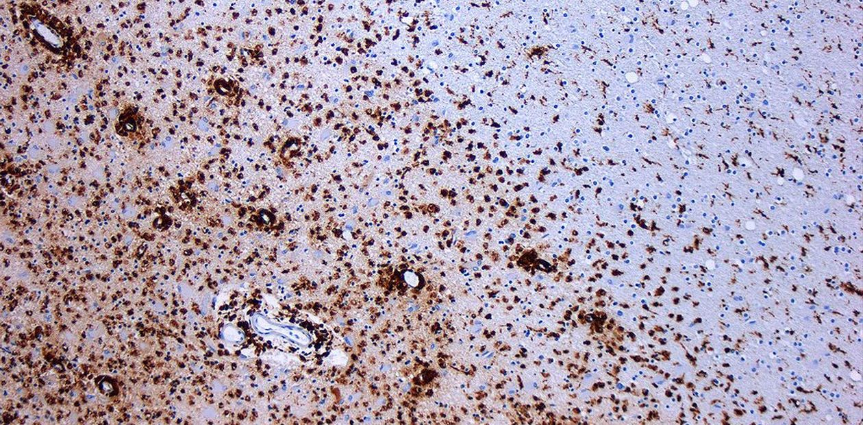 Рассеянный склероз: можно ли восстановить миелин?