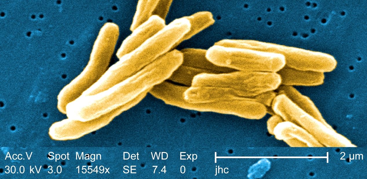 Туберкулез: кому не повезет заболеть