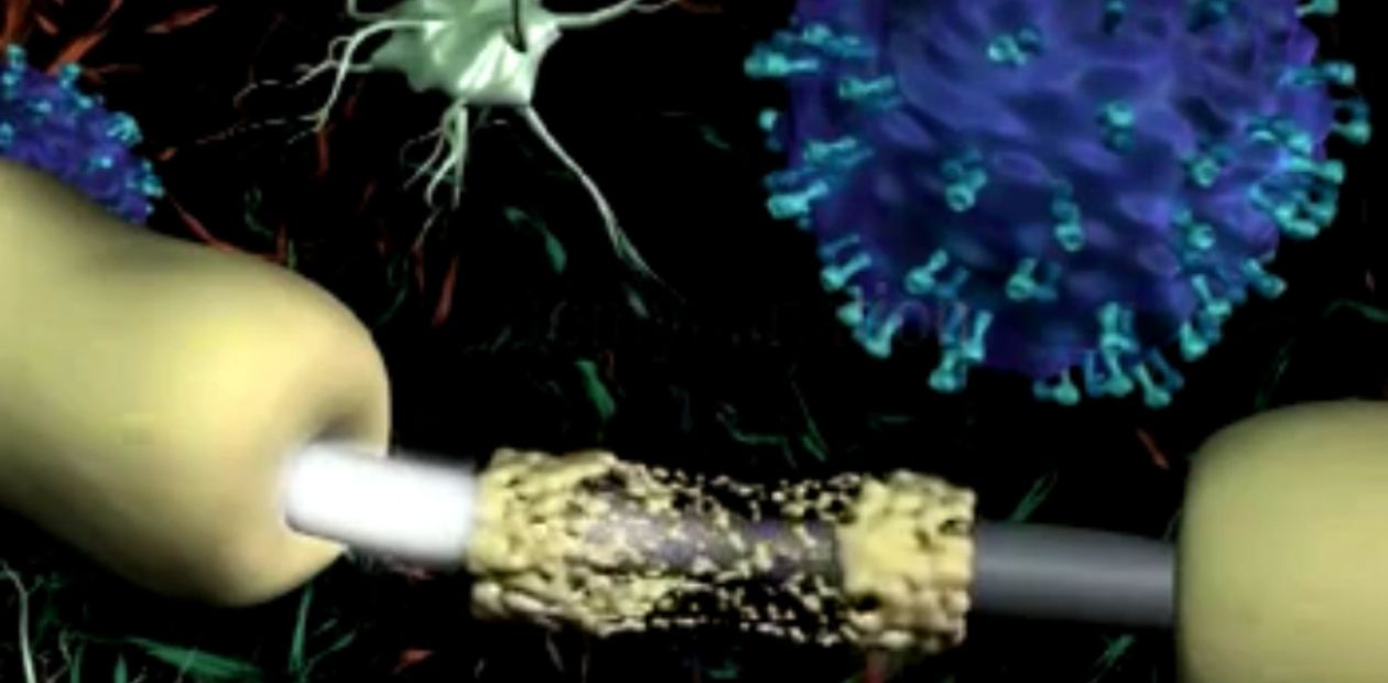 Рассеянный склероз: «приказы» иммунным клеткам передаются по лимфатическим сосудам мозговых оболочек