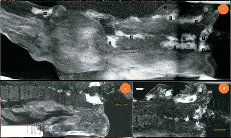 Рис. 7. Клетчаточные пространства (MPR 3D-реконструкция). Обозначения: 1 – правая молочная железа; 2 – премаммарное клетчаточное пространство, справа; 3 – аксиллярное клетчаточное пространство, справа; 4 – клетчаточное пространство шейногрудного перехода, справа; 5 – клетчаточное пространство шейногрудного перехода, слева; 6 – подкожно по задней поверхности грудной клетки, справа; 7 – подкожно по задней поверхности грудной клетки, слева; 8 – подкожно по задней поверхности брюшной полости, справа; 9 – клетчаточные пространства малого таза, справа; 10 – паховое клетчаточное пространство, справа. Рис. 8. Левая молочная железа – достаточно гомогенной МР-структуры. Контур органа показан полыми стрелками. Видна жировая ткань левой аксиллярной ямки (без отечности и без узловых включений) и левый плечевой сустав. Серия вертикальных зеленых стрелок показывает уровни по позвоночнику. DISSECTION – уровень артифициального рассечения на уровне шейно-грудного перехода. Рис. 9. Правая молочная железа (указано закрашенной стрелкой). В структуре железы имеется сфероидный узел (тонкая стрелка). В подмышечной впадине можно видеть два овоидных плотных объекта (две молниеобразные стрелки). Серия вертикальных зеленых стрелок показывает уровни по позвоночнику. DISSECTION – уровень артифициального рассечения на уровне шейно-грудного перехода