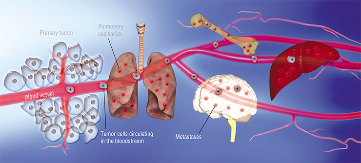 Some of the primary tumor cells enter the bloodstream or the lymph flow and travel along the vessels. Eventually, they are trapped in narrow capillaries in the organs, stick to their inner surface and enter the organ stroma from the vessels. Very few cancer cells survive this transition, however, those that do can form new growth sites, i.e. metastases. Based on: (Massagu, Obenauf, 2016)