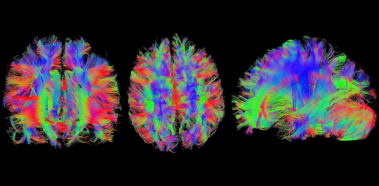 Визуализация проводящих путей головного мозга с помощью МРТ © GR_Image (pixabay.com)