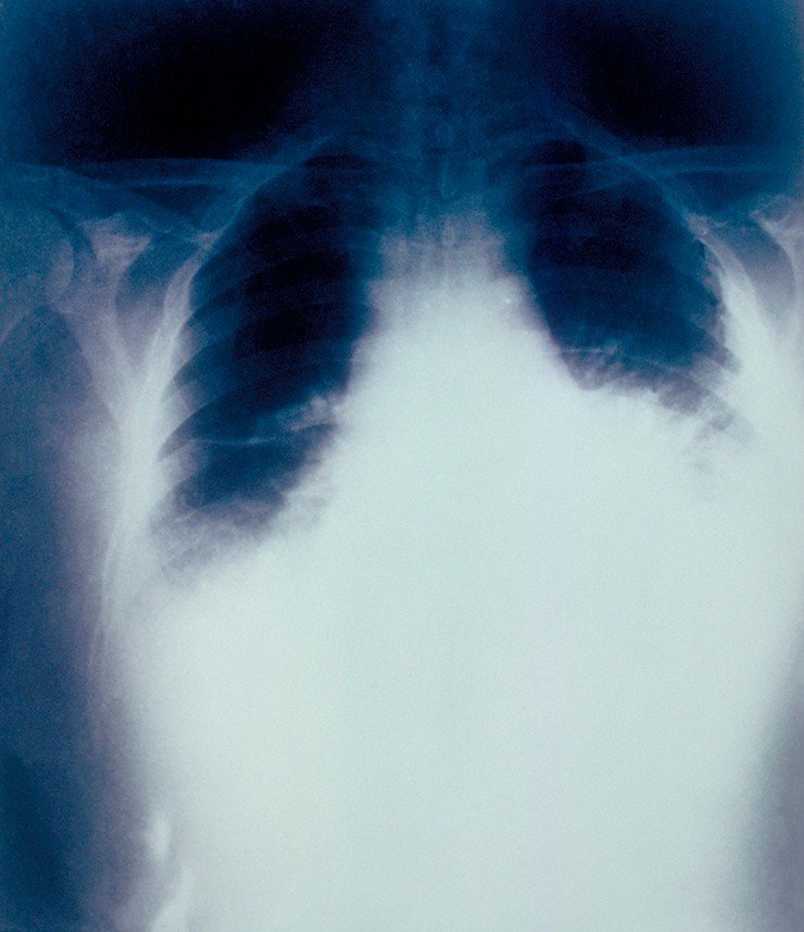 На рентгенограмме больного, заболевшего легочной формой сибирской язвы после вдыхания бактериальных спор, видно расширение средостения – части грудной клетки между легкими.  Рентгенологическое исследование проведено за 22 ч. до смерти. Легочная форма заболевания – одна из самых тяжелых и даже при соответствующем лечении приводит к летальному исходу в 90—95% случаев. CDC, Public Domain