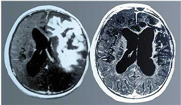 These tomographic images document one of the most amazing cases of curing cancer using viral therapy, described in the Journal of American Medical Association (JAMA) in 1999. The patient was a fifteen year-old teenager with glioblastoma, the most dangerous and aggressive type of brain tumors. The tumor occupied a large volume in the brain, and other types of therapeutic interventions were impossible. According to a personal communication from one of the authors of this paper, the patient was alive and actively working for several years. Based on: (Csataryand, Bakacs, 1999)