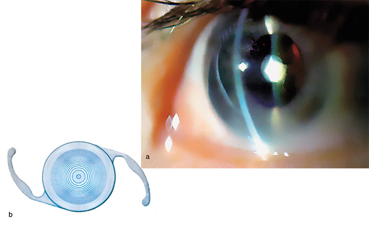 The surgery of cataract implies intraocular lens implantation. (a) An eye with anterior polar cataract and (b) a bifocal intraocular lens, developed at the Institute of Automatics and Electrometry, Siberian Branch of the Russian Academy of Sciences (Novosibirsk, Russia)