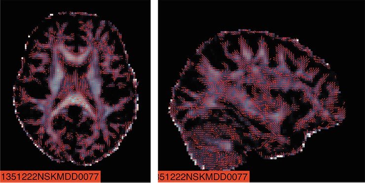 С помощью современного диффузионно-тензорного метода нейровизуализации, основанного на данных диффузии воды в тканях, можно наглядно представлять и анализировать распределение в полушариях головного мозга «белого вещества», образованного нервными волокнами. На фото – разные проекции проводящей структуры полушарий головного мозга. Данные получены в рамках рабочей группы ENIGMA-MDD