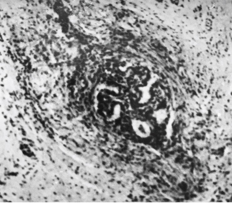 Случай папиллярной микрокарциномы щитовидной железы. Опухоль представлена несколькими железисто-папиллярными структурами в центре микрофотографии. Видна значительная лимфоидная инфильтрация, степень выраженности которой является важным прогностическим маркером не только рака щитовидной железы, но и, в принципе, всех злокачественных опухолей. Маленькие черные клетки – это лимфоциты. По: (Заридзе, 1973)