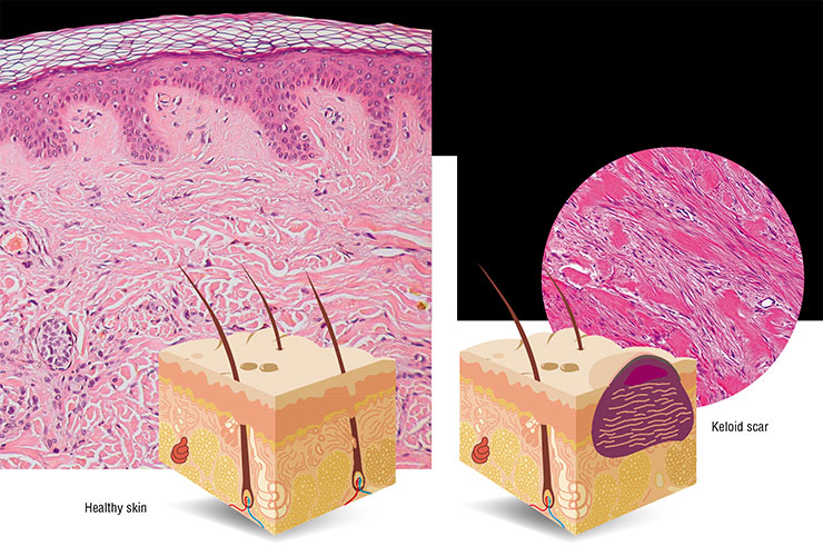 Scar tissue differs from normal skin – it consists primarily of collagen, exhibits higher sensitivity to ultraviolet radiation, and lacks sweat and hair follicles. A pathological repair may lead to the formation of a keloid scar, i.e., a tumor-like overgrowth of coarse fibrous connective tissue (below). Photo: Public Domain/Kilbad and © CC BY-SA 3.0/ LWozniak&KWZielinski