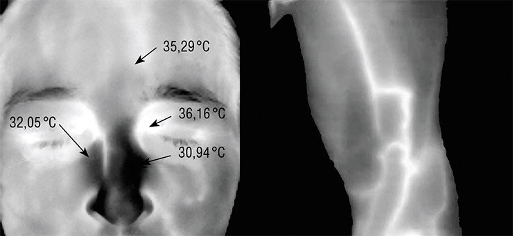 Термограмму можно использовать для диагностических целей: о наличии воспалительных процессов гайморовых полостей свидетельствует температурная асимметрия в области носа (слева); о варикозной болезни – «помеченные» высокой температурой расширенные вены нижней конечности (справа)