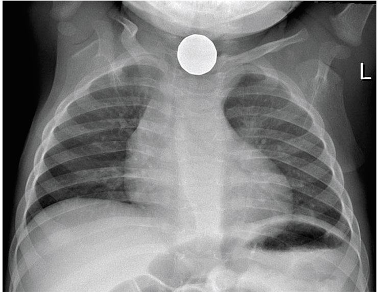 На рентгенограмме грудной клетки 9-летней девочки из Венесуэлы видна местная 25-центовая монета, застрявшая в верхней части пищевода. © CC BY-SA 4.0/ Isidro Ruiz, MD