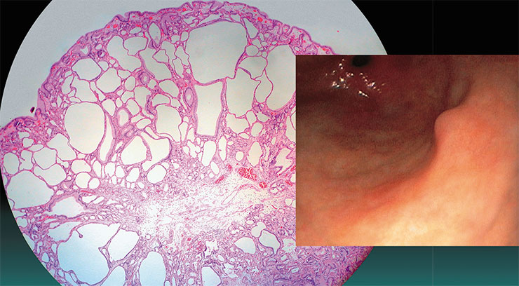 Около 74% всех полипов желудка образуется из фундальных желез, продуцирующих желудочный сок. Слева – одиночный полип размером 0,6 см, сформировавшийся из фундальной железы тела желудка у пациентки с гастроэзофагеальным рефлюксом. © CC BY-SA 4.0/ Ed Uthman. Справа – одиночный полип желудка, обнаруженный при эндоскопии. Фото А. С. Якушина (ЦНМТ, Новосибирск)