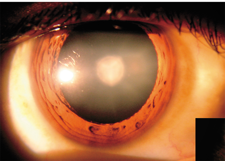 Cataract is a solar “eclipse” of the eye lens. © Rakesh Ahuja, MD; CC BY-SA 3.0