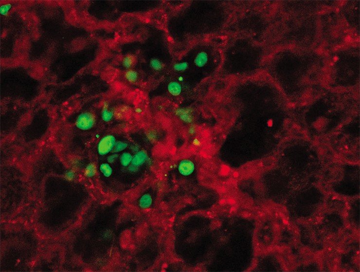 Раковые клетки (окрашены зеленым), покидающие кровеносный сосуд (окрашены красным) и колонизирующие строму легкого. Мультифотонная флуоресцентная микроскопия. Микрофотография A. M. Гуилиани (Дания)