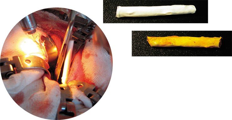 Как показали клинические исследования, стенты из «Биопластотана» можно устанавливать в желчные протоки малоинвазивным способом (слева). На фото вверху – билиарный стент до и после пребывания в организме животного в течение 100 суток