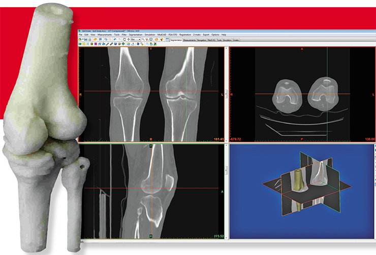 Preparation of the file for the additive manufacturing basing on the CT scan data can take up to one full day. During another day an anatomically precise pre-operative bone model can be manufactured in polymer (left). Shown images were treated using commercial software “Mimics” by Materialise