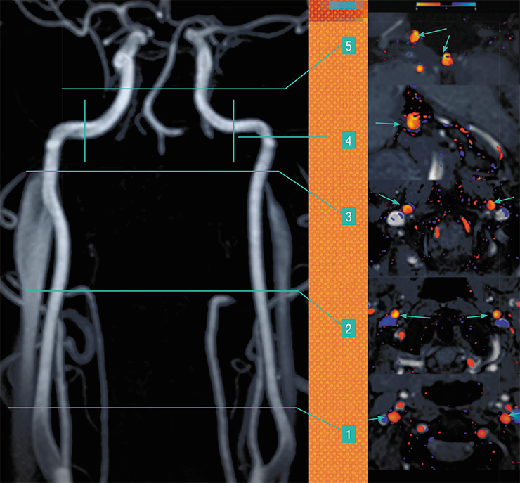 С помощью двумерной фазово-контрастной МР-ангиографии (2D PCA) можно оценить количественные характеристики магистрального кровотока на нескольких уровнях в просвете мозговых артерий. Вверху – визуализация неравномерности распределения скоростных характеристик в просвете разных сегментов внутренних сонных артерий – парных крупных артерий шеи и головы, по данным 2D PCA. Срезы устанавливались перпендикулярно ходу артерий на шейном уровне, с одновременным захватом правого и левого сосуда. В специальной программе полученные томограммы обрабатывались с созданием геометрической фигуры, отграничивающей так называемую область интереса (в данном случае – просвет артерии), внутри которой определялись значения объемной, пиковой и средней скоростей кровотока, а также площадь поперечного сечения сосуда в каждую из фаз цикла сердечной деятельности. Цифрами отмечены уровни визуализации кровотока во внутренних сонных артериях, стрелками – просветы артерий на разных уровнях