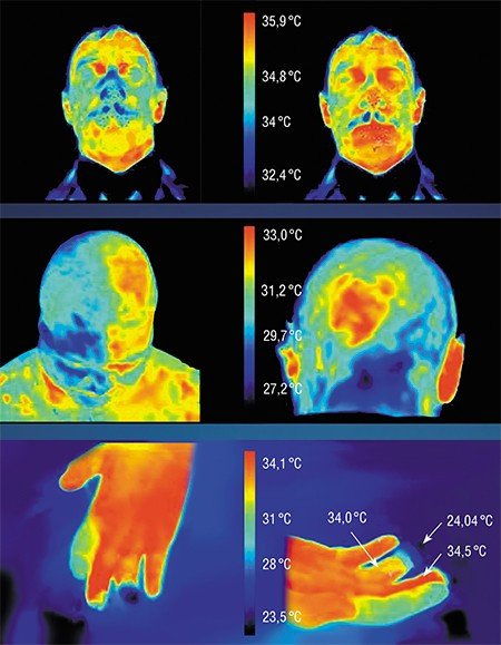 В верху: Повышение температуры лица здорового испытуемого через пять минут после принятия биологической добавки «Янтарь антитокс» (справа) происходит вследствие улучшения кровообращения. В центре: Злокачественные новообразования характеризуются повышенной температурой, поэтому термограмма лица позволяет локализовать опухоли в случае ходжкинской лимфомы (слева) и менингиомы (справа). Внизу: О некрозе фаланги безымянного пальца этой руки свидетельствует относительно более низкая температура пораженного пальца 