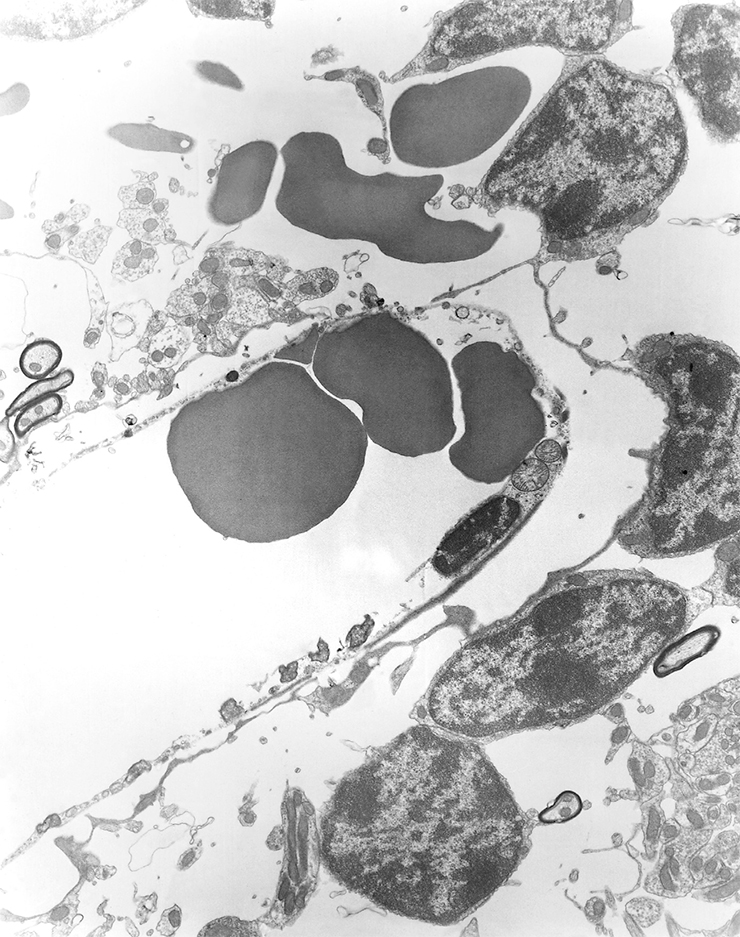 The image of a brain capillary of a mouse experimentally infected with the rickettsial bacteria Orientia tsutsugamushi shows evidence of hemorrhage and edema (lower left). In the cytoplasm of a dying vascular-endothelium cell, one can see several cells of the pathogenic bacterium. Transmission electron microscopy. Photo 1976. © CDC
