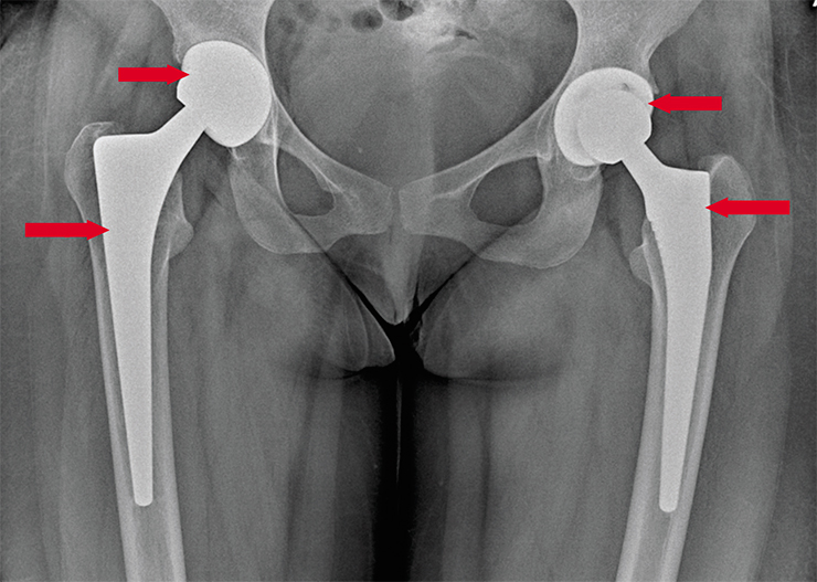 На рентгенограмме видны эндопротезы тазобедренных суставов, которые были установлены пациенту c последней стадией полиартрита. (НИИКЭЛ СО РАН, Новосибирск)
