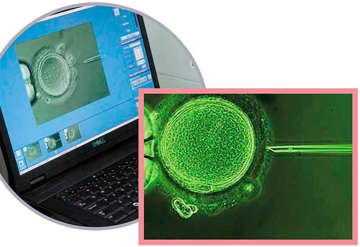 При методике ИКСИ яйцеклетку оплодотворяет путем инъекции в нее единственного сперматозоида. С помощью микроманипулятора капилляр прокалывает оболочку яйцеклетки, и сперматозоид вводится в цитоплазму. Процесс визуализируется с помощью цифровой камеры, передающей изображение на экран компьютера