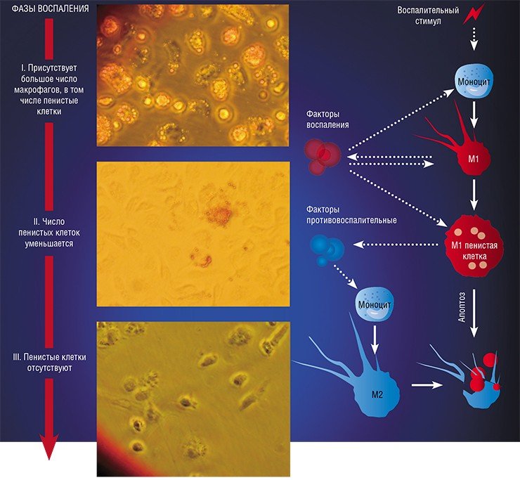 Макрофаги образуются из клеток-предшественников (моноцитов) уже в самые первые часы воспаления, вызванного определенным стимулом (например, бактерией). Макрофаги М1 и пенистые клетки начинают продуцировать провоспалительные факторы и кислородные метаболиты и активно захватывать «чужеродные» молекулы. На 1—3-е сутки воспалительного процесса пенистые клетки начинают секретировать противовоспалительные факторы, которые активируют липидные сенсоры моноцитов, мигрирующих из русла крови в очаг воспаления. Так образуются макрофаги М2. Сами пенистые клетки погибают в ходе запрограммированной клеточной смерти (апоптоза) и поглощаются макрофагами М2. Это сигнал о завершении воспаления (5-е сутки). На фото – фазово-контрастная микроскопия клеток, полученных из перитонеальной полости мышей при воспалении