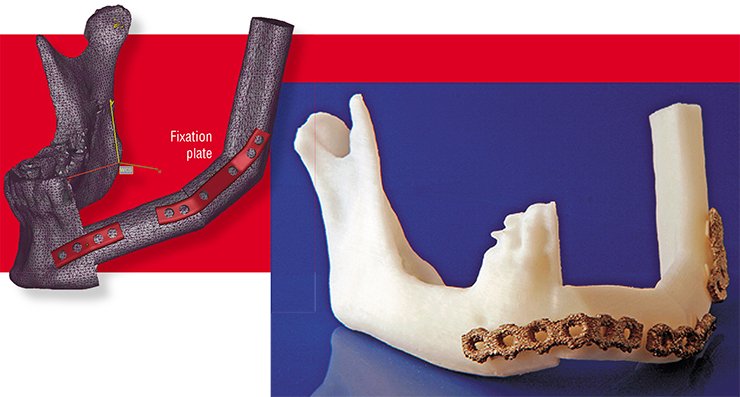 Today seven patients in Sweden have received individually fit implants and fixation plates made in the additive manufacturing laboratory at Mid Sweden University. The pictures above illustrate a complex medical case of the lower jaw bone reconstruction. The missing jaw bone fragments were replaced with sections of the patient’s fibula. Left: the CAD model of the bones and anatomically fitted fixation plates, with the surfaces approximated by a large number of flat polygons to provide faster data processing (so called polygonal approximation). Right: the plastic pre-operative model and the fixation plates made using AM technology from the medically approved aluminum-titanium-vanadium alloy