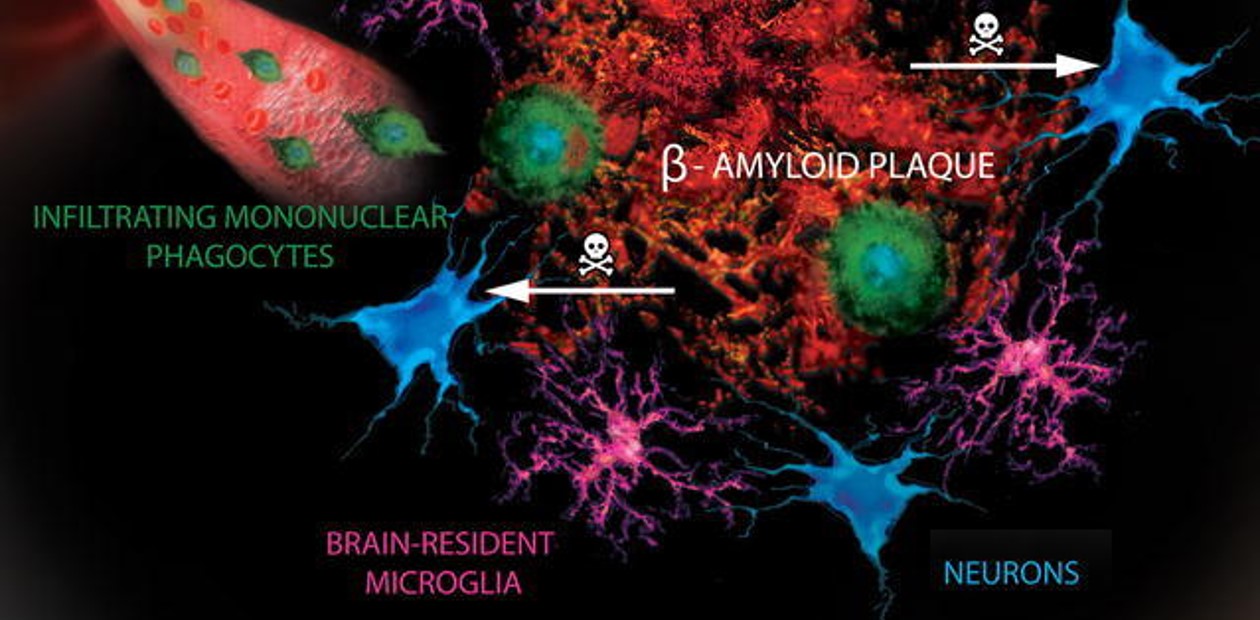 Глиальные и периферические макрофаги уничтожают отложения бета-амилоида в головном мозге при болезни Альцгеймера
