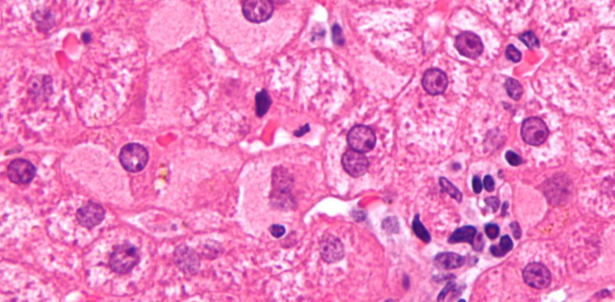 Образец биопсии печени при хроническом гепатите В с высокой вирусной нагрузкой, на котором видны «характерные для инфекции «стекловидные» гепатоциты