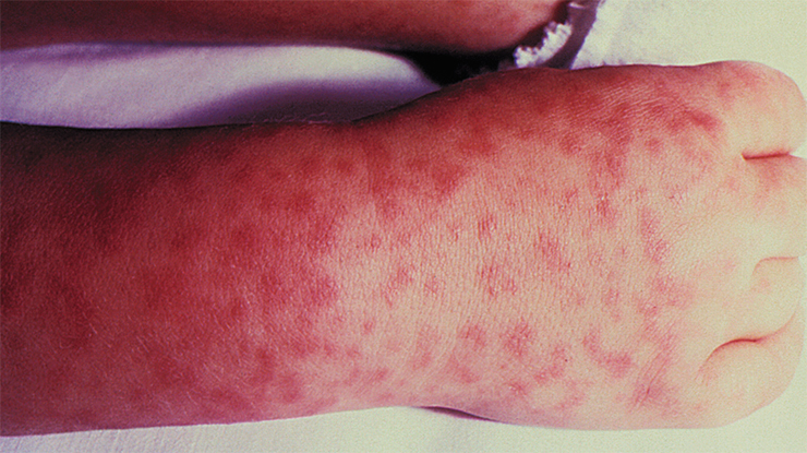 A child’s hand covered with a papulous rash typical of RMSF, the most severe and most commonly reported rickettsiosis in the United States. © CDC