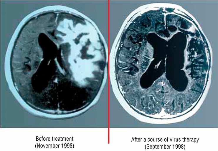These tomograms demonstrate one of the most astonishing cases of recovery from cancer with the help of virus therapy, reported by the Journal of American Medical Association (JAMA) in 1999. The patient was a boy of 15 with glioblastoma, the most dangerous and rapidly developing brain tumor. The therapy with Newcastle disease virus was used, since the tumor occupied a considerable part of the brain and no other therapeutic intervention was applicable. According to oral communication of one of the authors, this patient is still alive and successfully works. (Csataryand, Bakacs, 1999)