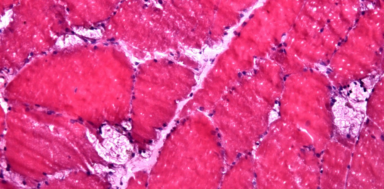 При болезни Помпе в лизосомах – клеточных органеллах, накапливается нерасщепленный гликоген (красным цветом). Окраска гематоксилин-эозином