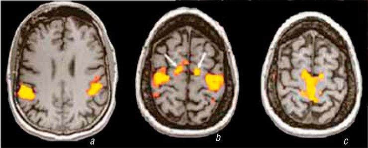 Various cognitive and motor operations are accompanied by the activation of different brain zones. Right: The patterns of activation zones in the motor areas along the central brain fissure when a person is (a) saying a tongue twister, (b) successively tapping their fingers, and (c) flexing and stretching their legs. (Leach and Holland, 2010)