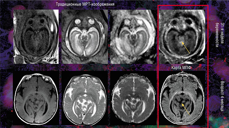 Метод быстрого картирования макромолекулярной протонной фракции (МПФ), основанный на математической обработке обычных МРТ-изображений, можно использовать для внутриутробной диагностики врожденной злокачественной опухоли мозжечка, не выявляемой с помощью традиционного МРТ-обследования. По: (Коростышевская и др., 2020)