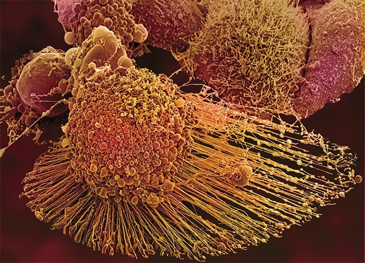 Среди всех линий человеческих клеток, непрерывно размножающихся в лабораторных условиях, самой известной является HeLa. Она была получена в 1951 г. из раковой опухоли шейки матки темнокожей американки Г. Лакс (Henrietta Lacks), умершей в том же году. С тех пор было опубликовано свыше 65 тыс. научных работ, выполненных с применением этих клеток. Но хотя сама клеточная линия потенциально «бессмертна», в стареющих или поврежденных клетках инициируется апоптоз (запрограммированная смерть). На поверхности умирающей клетки образуются пузыри (везикулы), называемые апоптотическими тельцами. Электронная микроскопия. Фото Т. Деринка и М. Эллисмана (Национальный центр микроскопии и исследования изображений, Калифорнийский университет в Сан Диего (NCMIR/UCSD), США)