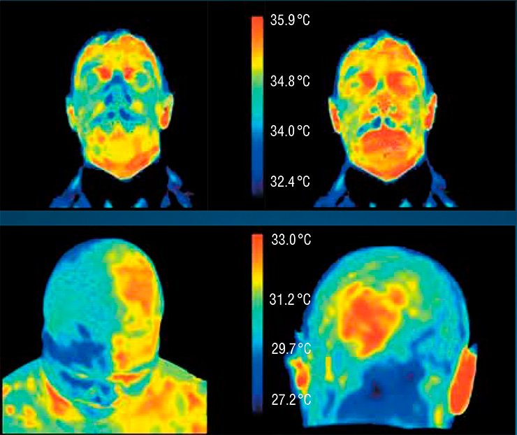The increase in the temperature of the face of a healthy test person in five minutes after swallowing the “Yantar antitoks” (Amber antitox) biologically active additive (right) occurs owing to improvement of blood circulation. Malignant neoplasms are characterized by an elevated temperature; therefore, the face thermogram ensures localization of tumors in the cases of the Hodgkin’s disease (left) and meningioma (right)