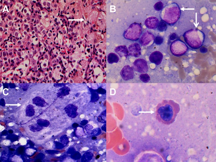 Раковые клетки при остром миелоидном лейкозе