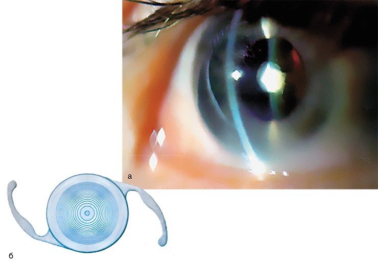 При хирургическом лечении катаракты пациентам имплантируется интраокулярная линза – искусственный хрусталик. а – глаз, пораженный передней прямой катарактой; б – бифокальная интраокулярная линза, разработанная в Институте автоматики и электрометрии СО РАН (Новосибирск)