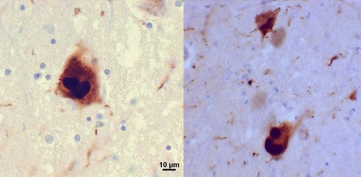 На микрофотографиях области черной субстанции у пациента с болезнью Паркинсона видны включения альфа-синуклеина