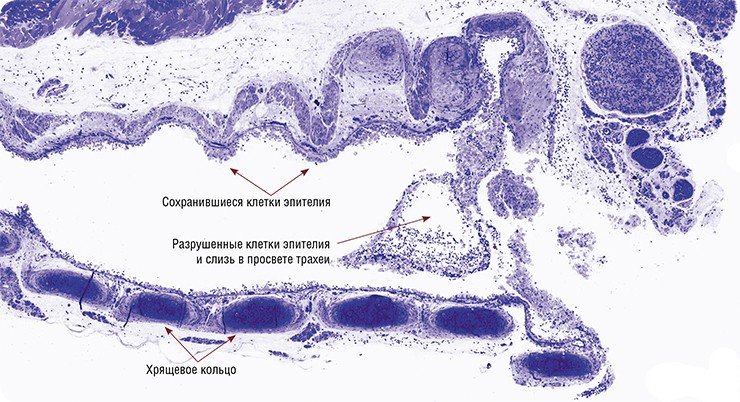 Светооптический препарат трахеи мыши, зараженной вирусом гриппа (полутонкий срез). За двое суток болезни вирус разрушил практически все клетки эпителия трахеи мыши (редкие сохранившиеся клетки показаны стрелками). Теперь стенка трахеи не защищена от бактериального «вторжения»