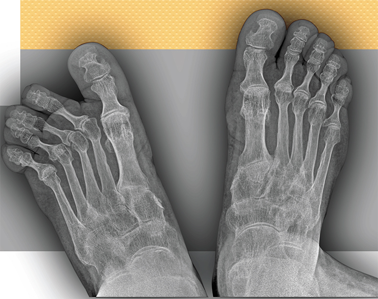 Рентгенограмма стоп при псориатическом артрите. Пальцы правой стопы отклонились в сторону из-за поражения суставов. Имеется характерный для этого артрита симптом «карандаша в стакане» – разрушение кости около сустава с «наползанием» на нижележащую кость